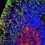 Imagen-MLToribio_Leucemia.jpg